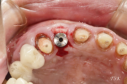 上顎前歯部骨造成インプラントの治療前